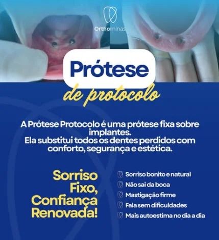 Informativo sobre prótese protocolo fixa sobre implantes